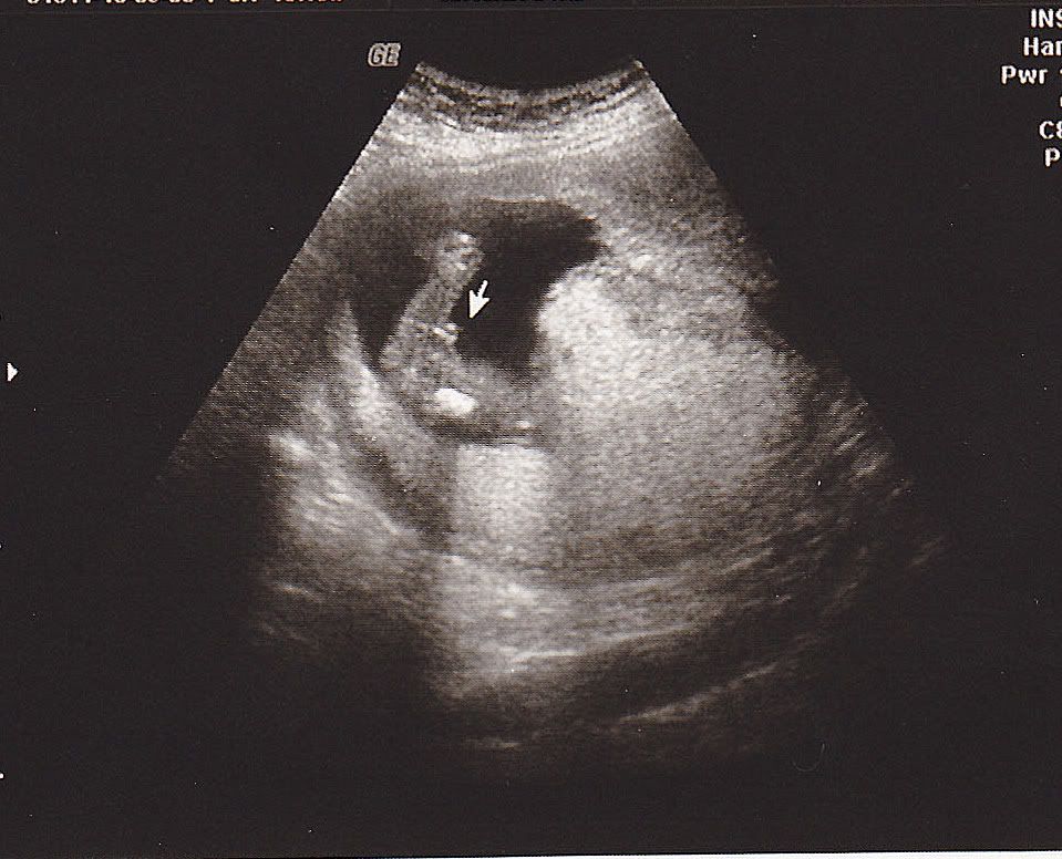16 weeks potty shot boy ? in Ultrasound Gender Prediction ...