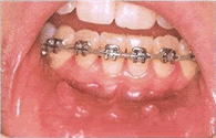 mouth ulcers - click to read how to treat them and other problems with braces