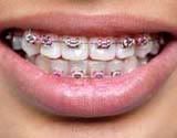 teeth in braces